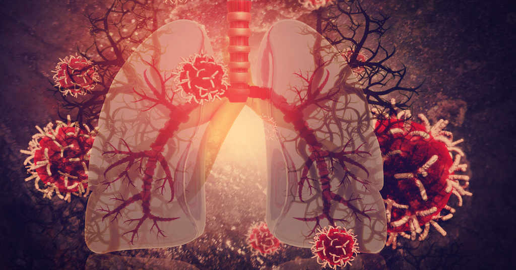 4 Types of Common Chronic Respiratory Disorders